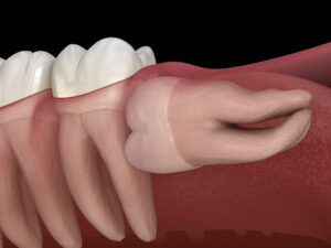 3D model of impacted wisdom tooth